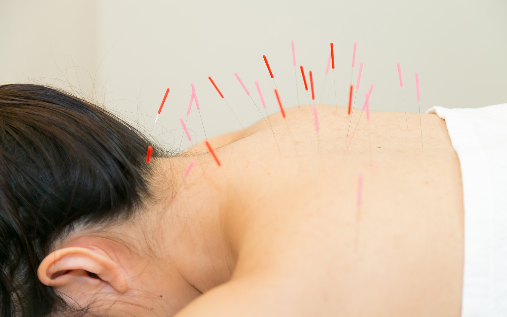 acupuncture
