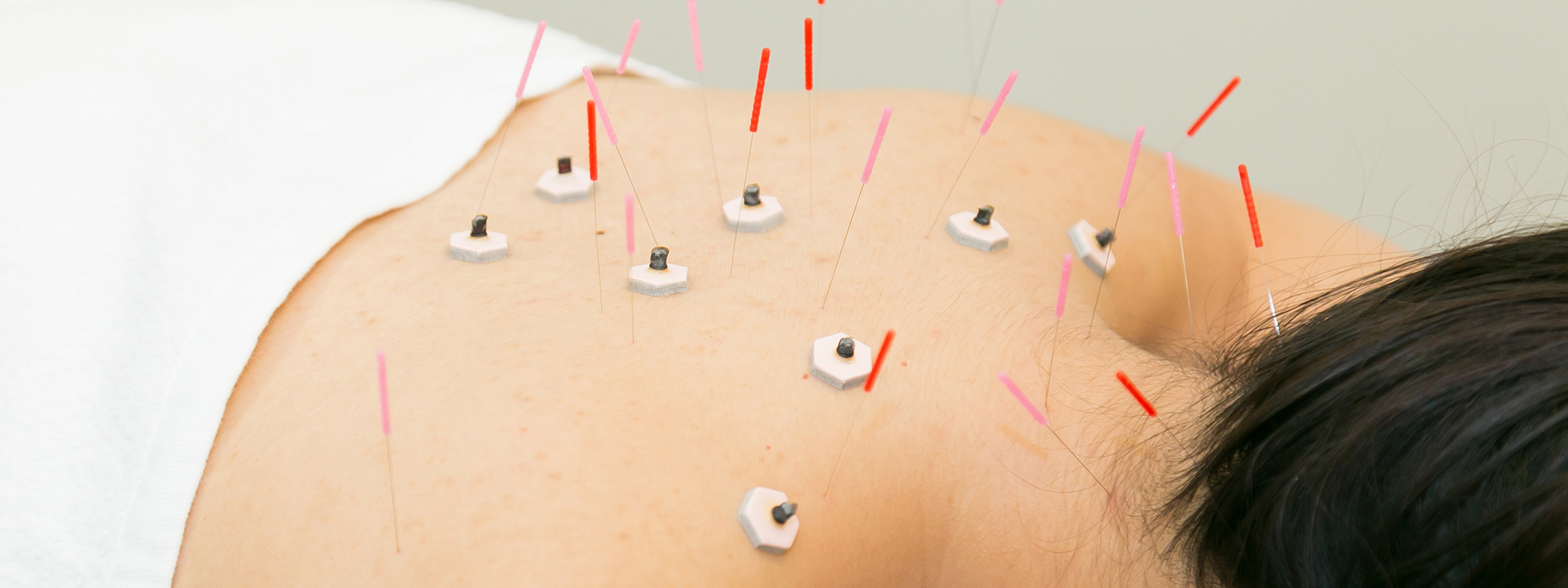 acupunctre