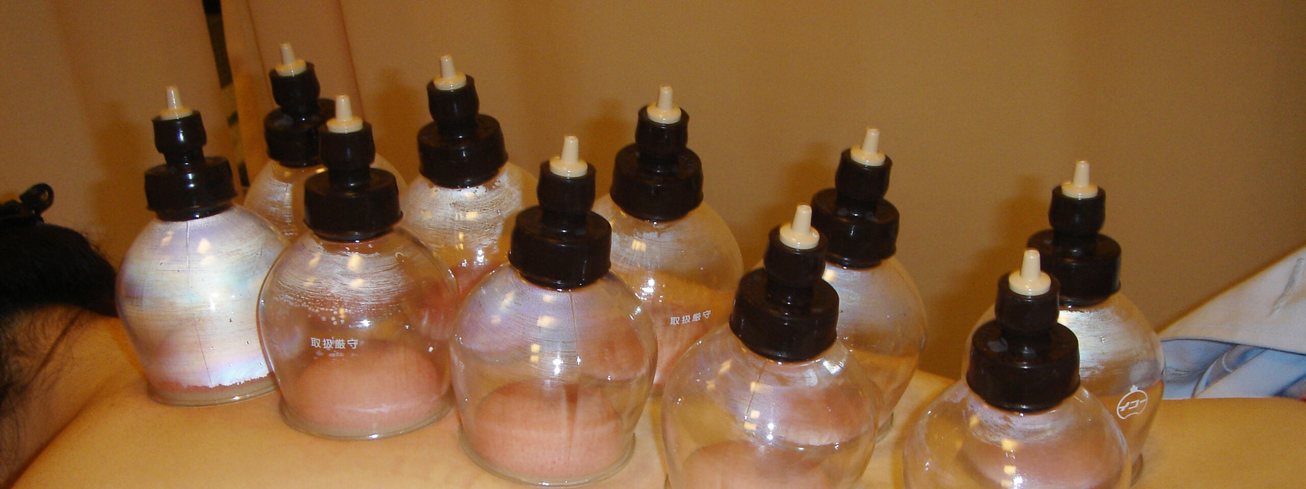 cupping