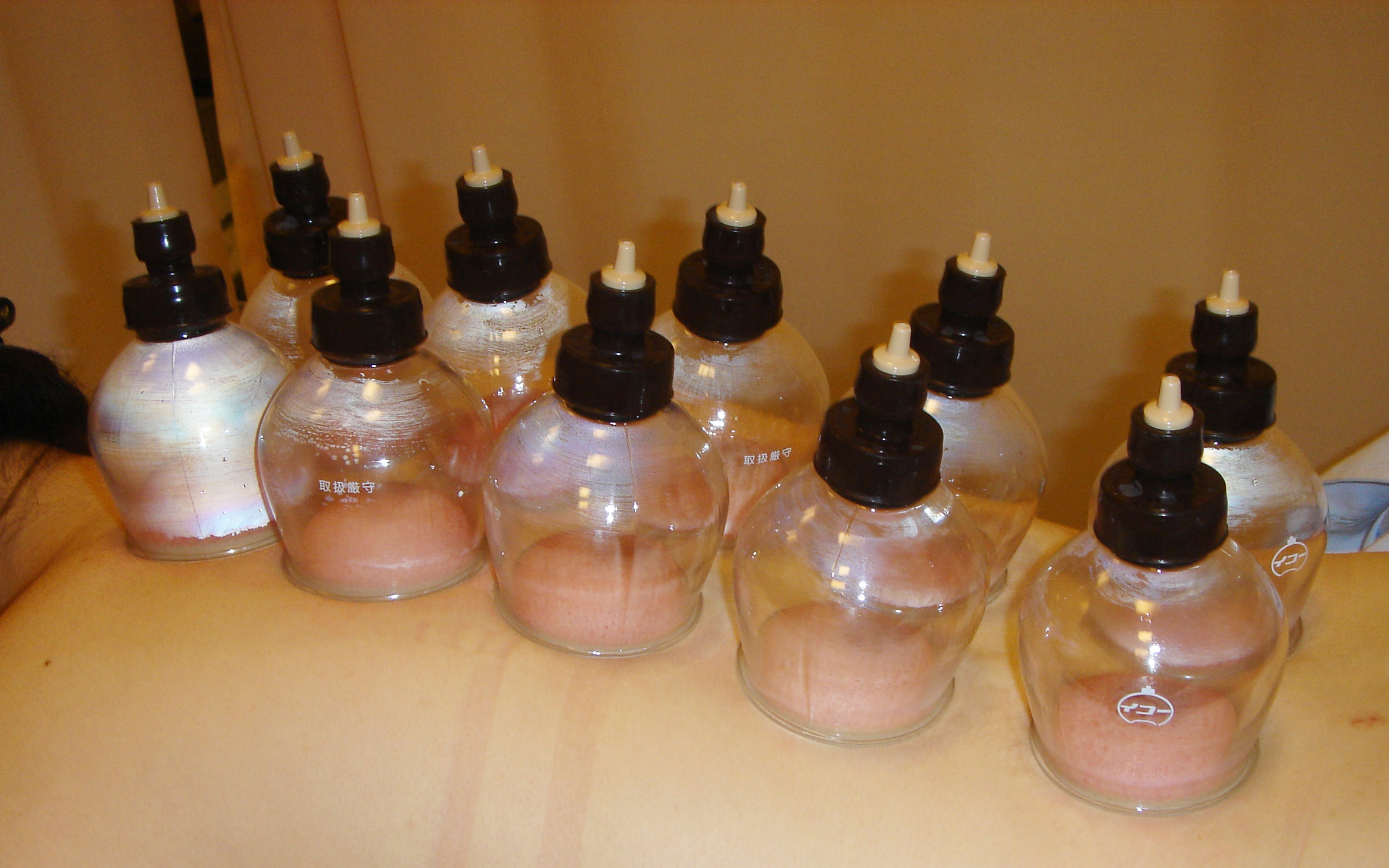 cupping
